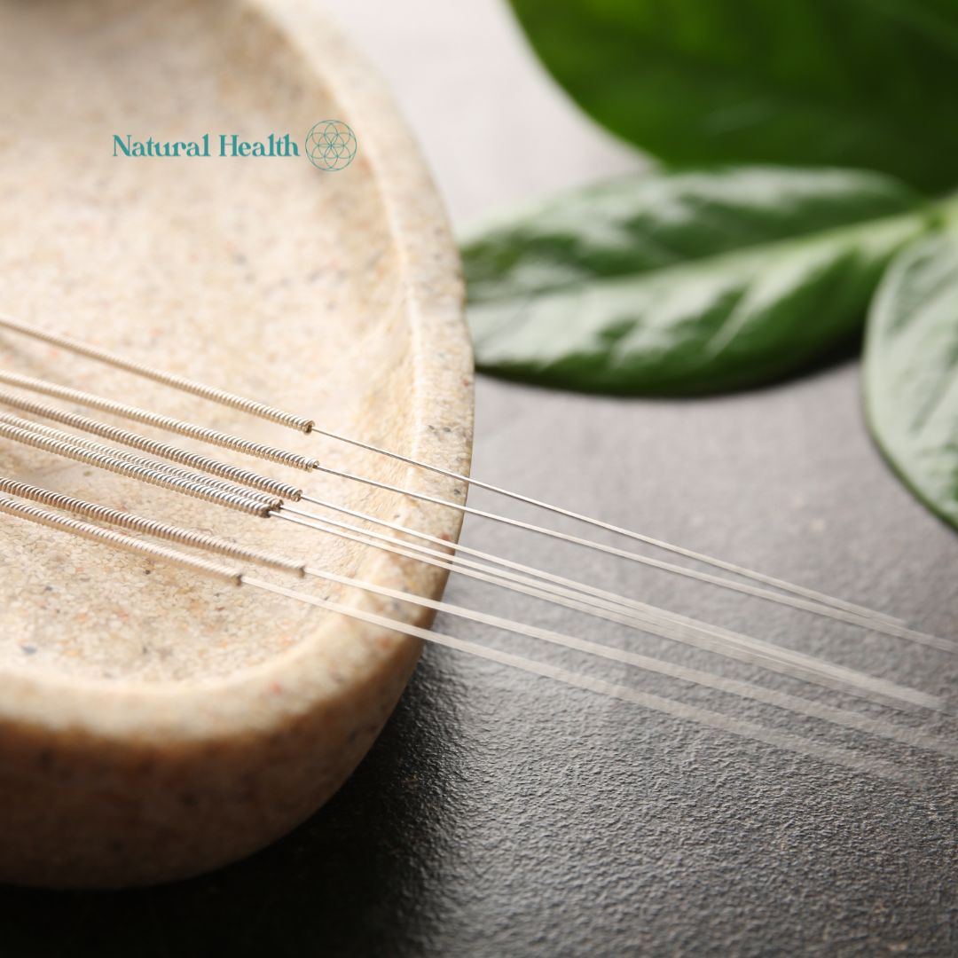 Fülakupunktúrás kezelési pontok tűkkel – természetgyógyászati módszer a stressz, fájdalom és egyensúlytalanságok enyhítésére.